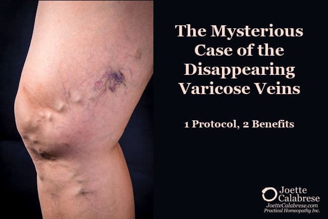 The Mysterious Case of the Disappearing Varicose Veins: 1 Protocol, 2 Benefits