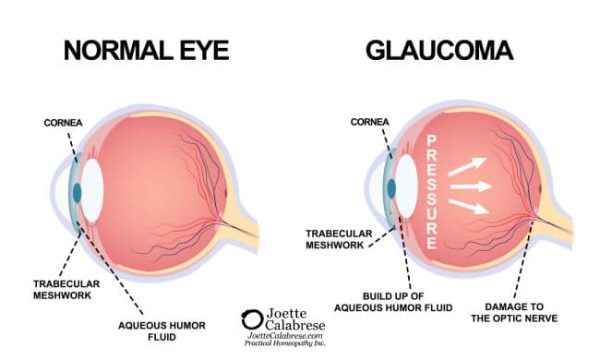 Joette Calabrese, Practical Homeoapthy®, Glaucoma: The Danger of Increased Intraocular Pressure