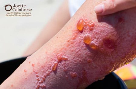Joette Calabrese, Practical Homeopathy®, 10. Poison Ivy: How to Antidote Poisonous Toxins With Homeopathy Series