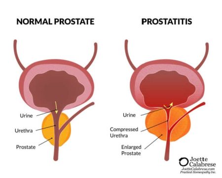 Joette Calabrese, Prostatitis: The Bane of Man’s Existence Alleviated With Practical Homeopathy®