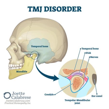 Joette Calabrese, TMJ Pain: Practical Homeopathy® Provides Jaw-Dropping Relief
